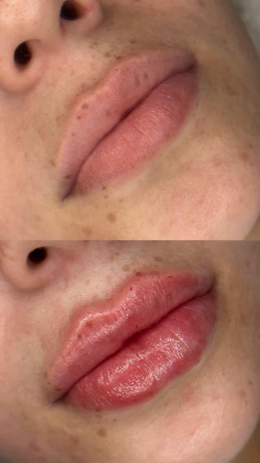 Preenchimento Labial — antes e depois 1
