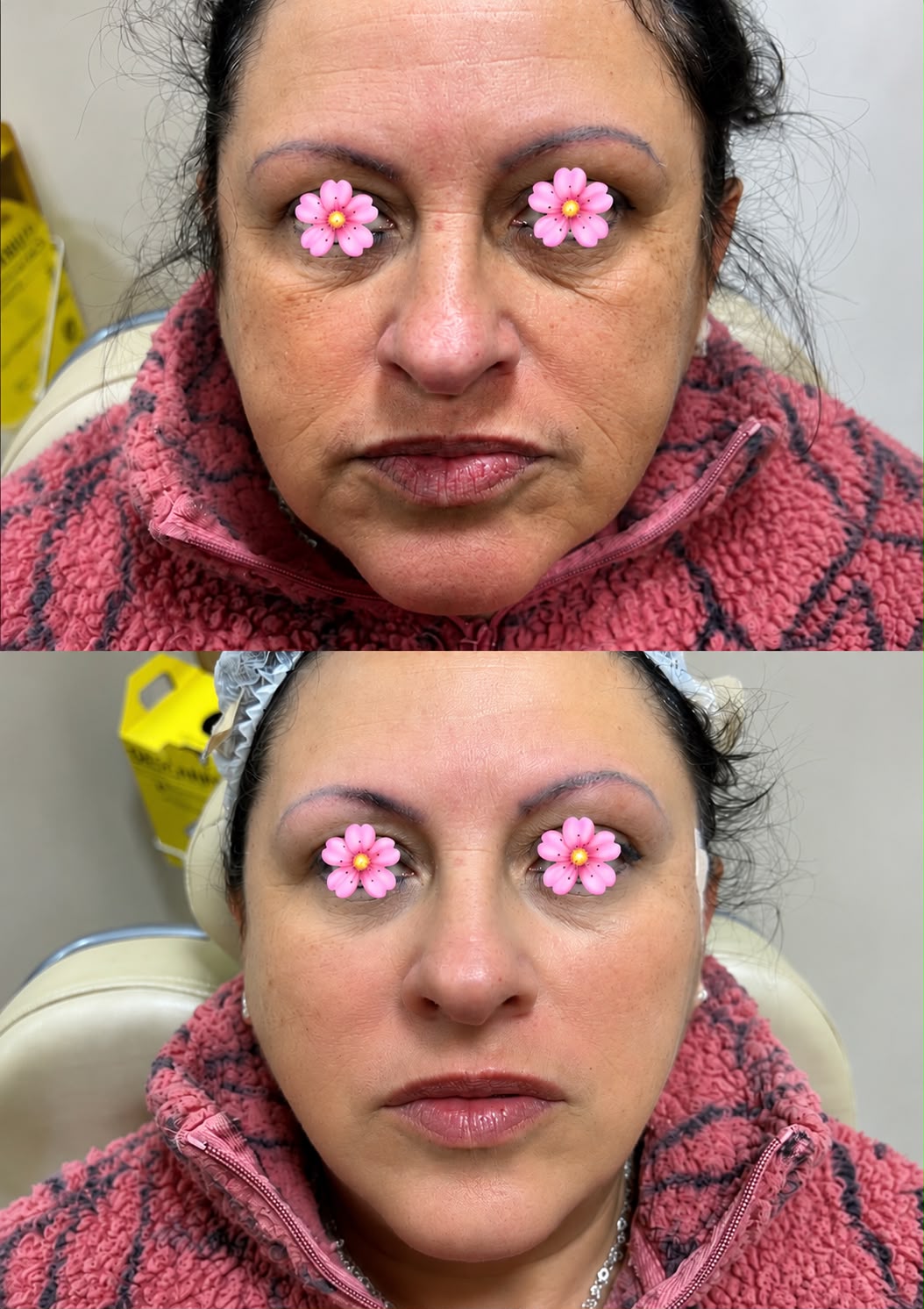 Bioestimuladores — antes e depois 1