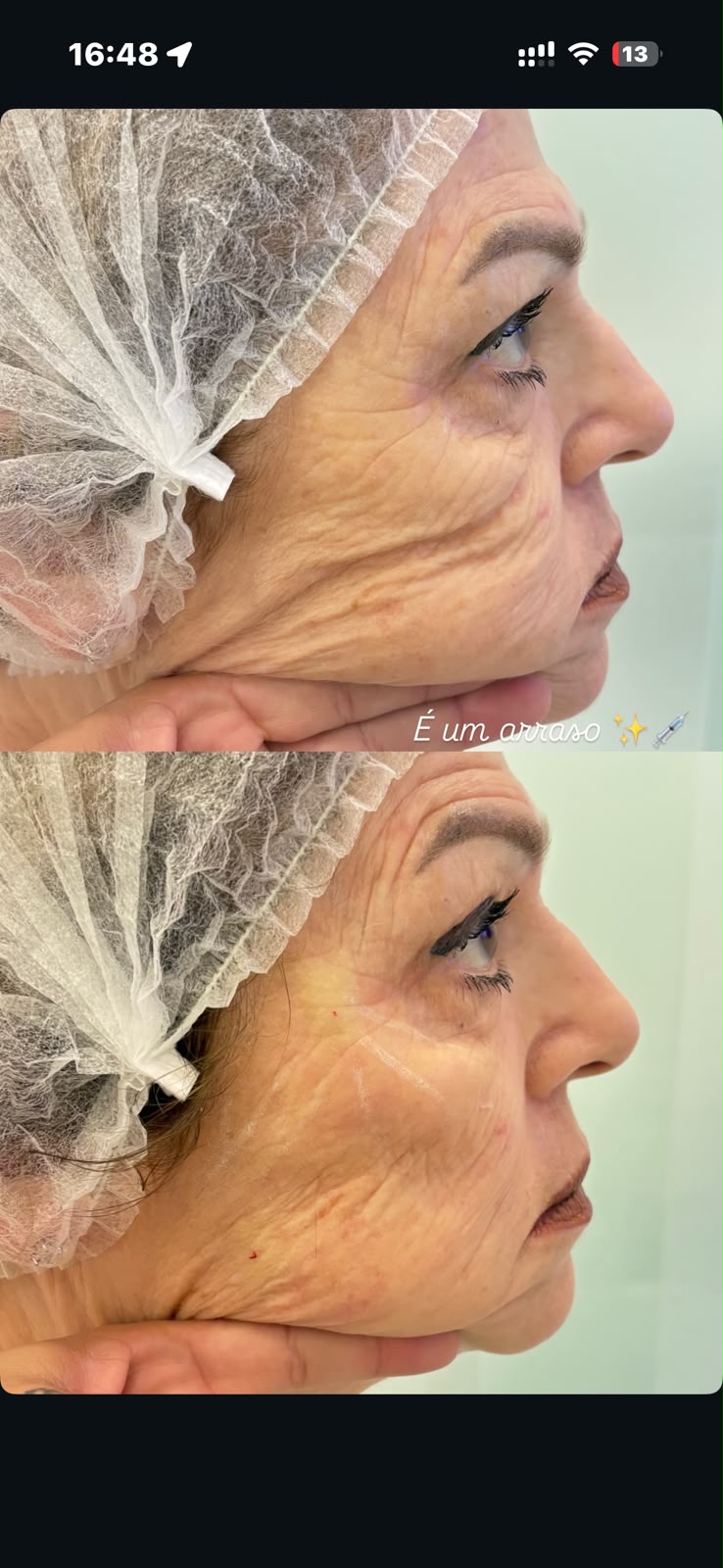 Ultraformer MPT — antes e depois 1