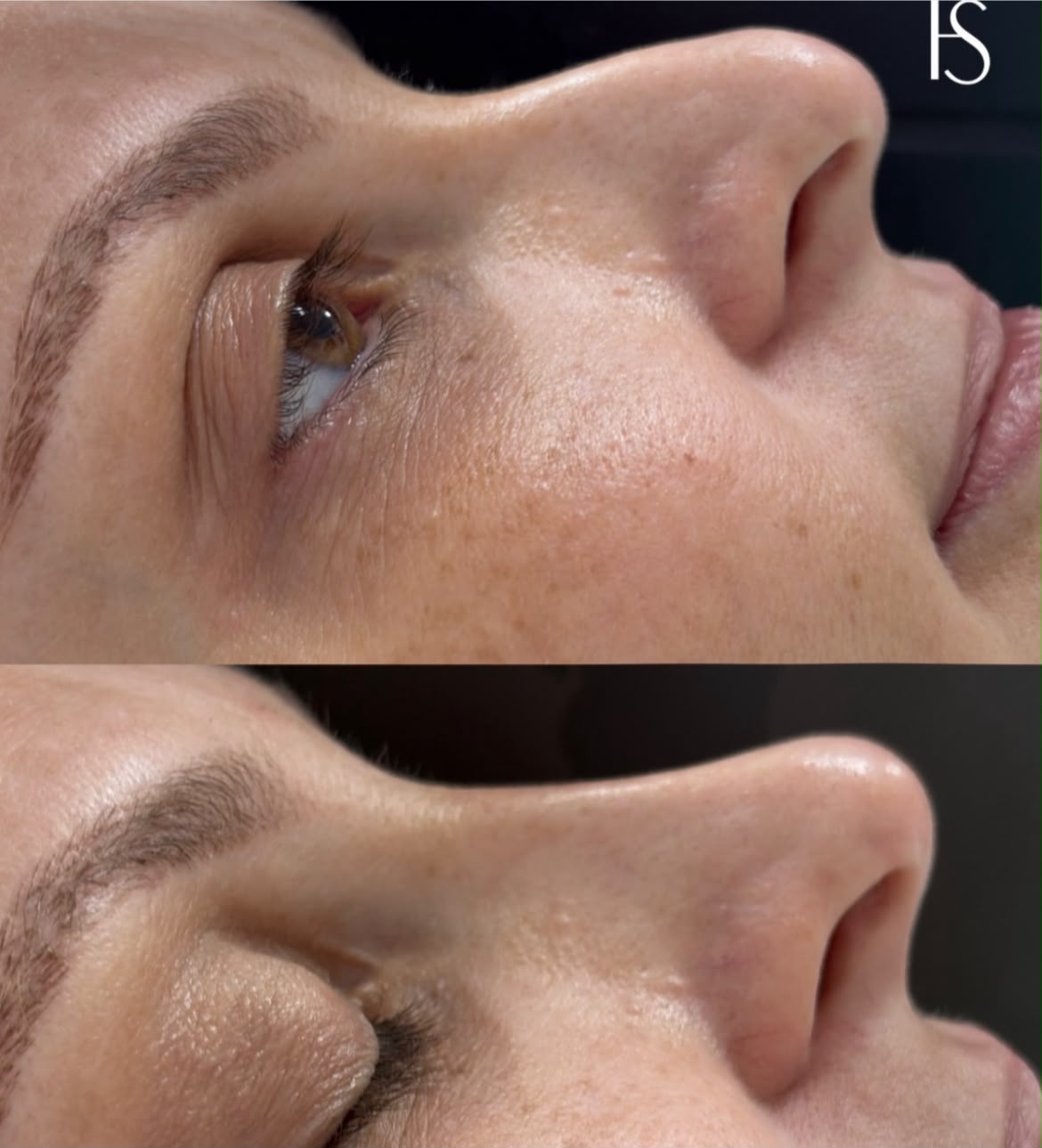 Rinomodelação — antes e depois 1