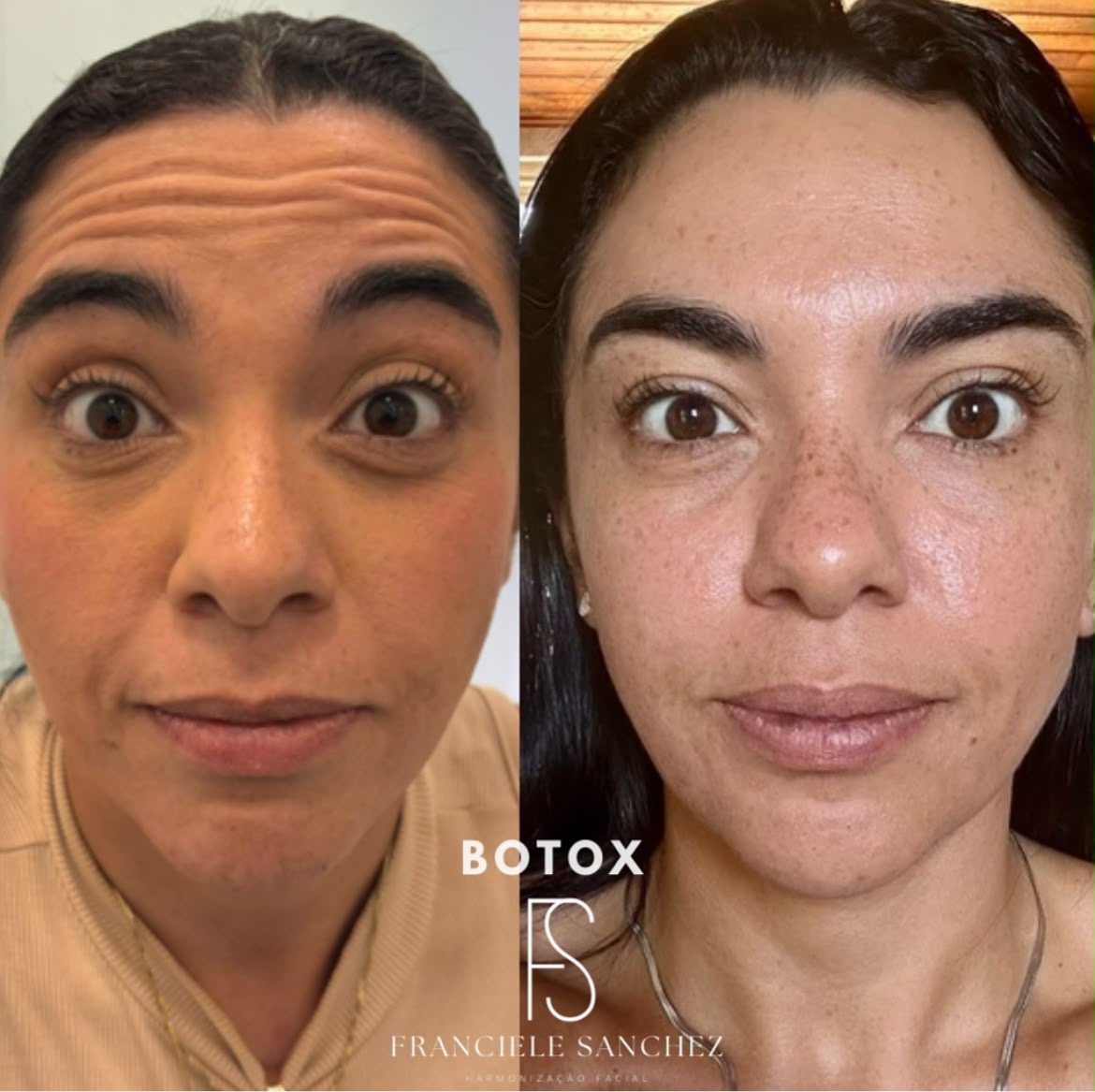 Botox — antes e depois 1