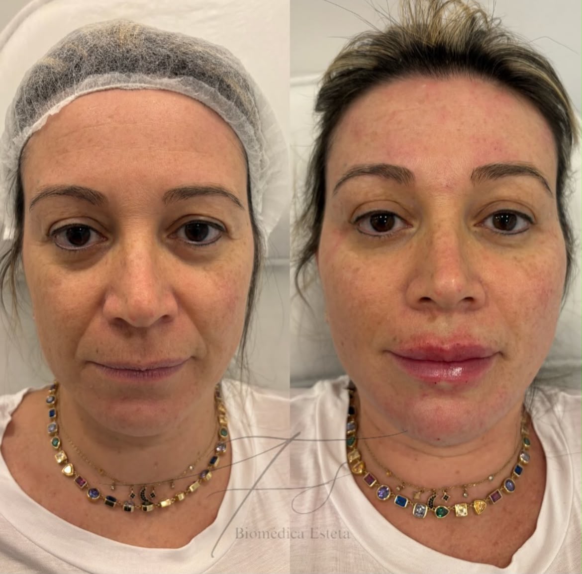 Preenchimento Labial — antes e depois 2