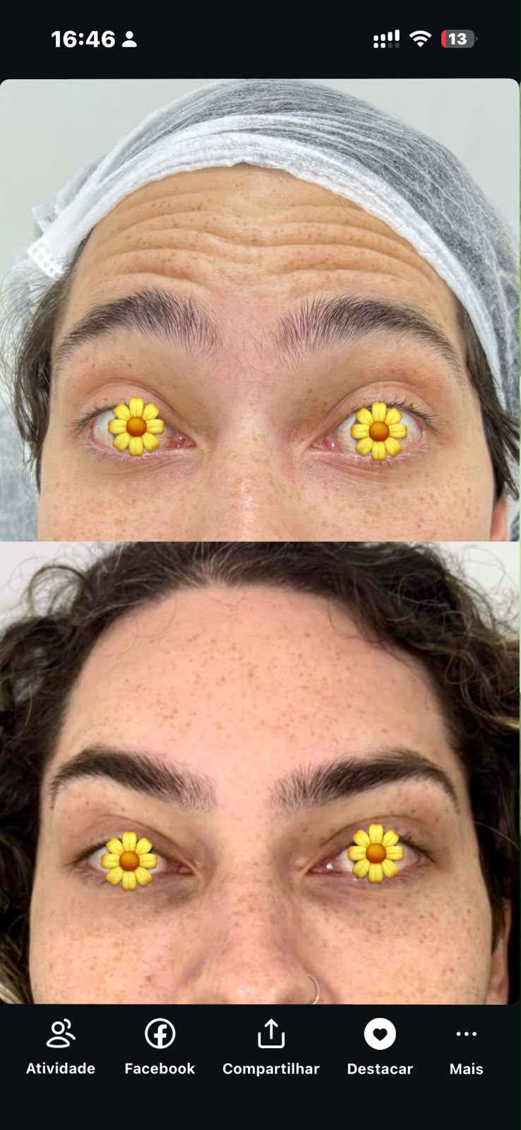 Botox — antes e depois 2